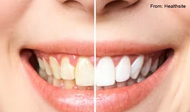 Dental Fluorosis Symptoms: 5 Warning Signs Of This Severe Metabolic Bone Disease